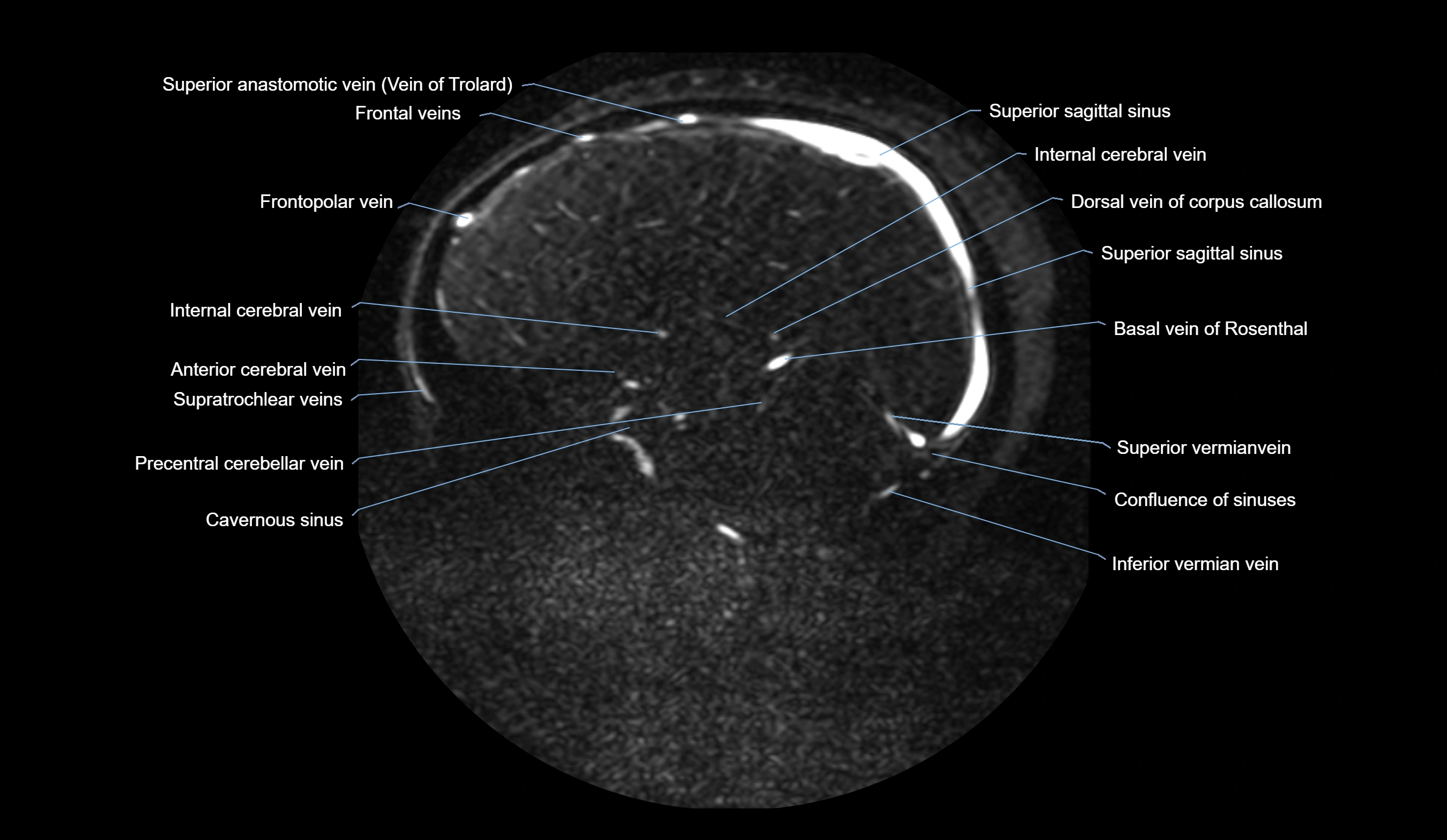MRV brain sagittal anatomy 3T MRI labelledimages -00046.webp